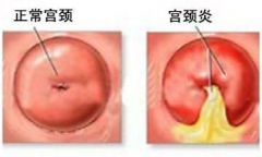 专家解析：宫颈炎的症状和治疗