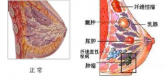 AIF磁定位超微创疗法治乳腺囊肿的临床效果观察