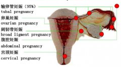 【图解疾病】宫外孕（异位妊娠）